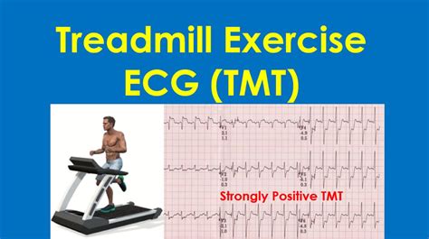 The Significance of Equivocal Exercise Treadmill ECG for.